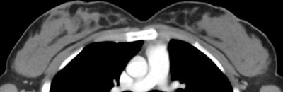 Axial CT of grade 4 density
