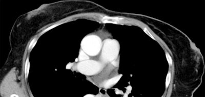 Axial CT images of a 70-year-old woman with grade 1 CT breast density (above) and a 42-year-old woman with grade 4 (below). All images courtesy of Radiology.