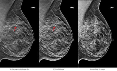 3D (tomosynthesis) image slice (left), C-View 2D image (center), and conventional 2D image (right). Images courtesy of Hologic.