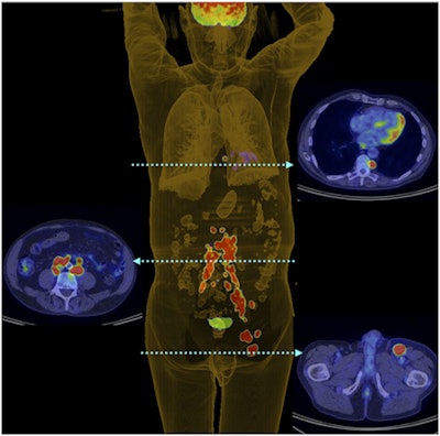 The winning image: 3D PET shows metastases in patient with Merkel cell carcinoma. Image courtesy of JNM.