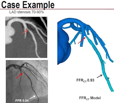 Invasive angiography and CT revealed 70% to 90% stenosis in the left anterior descending (LAD) artery. Conventional FFR and FFR-CT calculated nearly identical flow limitations. Image courtesy of Dr. Bjarne Nørgaard, PhD.