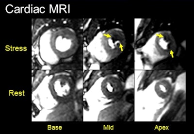 Images show concordant positive findings on stress CMR (above) and CTA (below) in a 42-year-old man with chest pain. The lateral wall stress-induced perfusion defect on CMR corresponds with the noncalcified severe stenosis involving a large obtuse marginal branch on coronary CTA. These CMR and CTA findings were confirmed on subsequent invasive angiography (bottom) with successful coronary stenting of the severe stenosis. All images courtesy of Dr. Marcus Chen.
