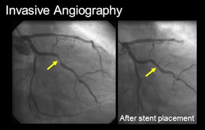 Invasive angiography