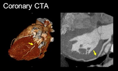Coronary CTA