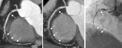 61-year-old woman (body weight, 65 kg; heart rate, 57 beats/min) with suspected coronary artery disease underwent two coronary CTA acquisitions using prospectively electrocardiogram-triggered high-pitch spiral technique. Multiple high-grade stenosis (local nearly occlusive) and noncalcified plaque of the right coronary artery are shown on maximum-intensity projection in both FBP (left) and IR (middle) series. The lesion was confirmed by subsequent coronary catheter angiography (right). The dose-length products were 62 and 31 mGy-cm for the FBP and IR protocols, respectively. Image courtesy of Dr. Bin Lu.
