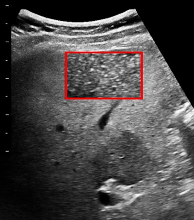 Broadband 6-MHz liver image with a 78 x 114-pixel region of interest.