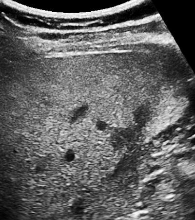 Mild fatty liver in a 42-year-old woman with a more intense patch posteriorly in the right lobe adjacent to spared peripheral patches. All images courtesy of Dr. Jason Birnholz.