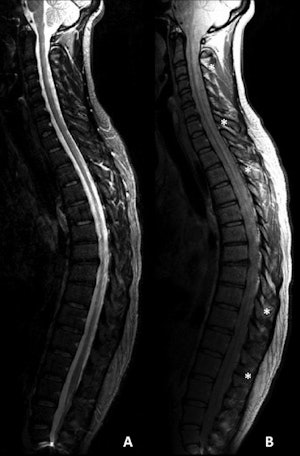 Sagittal T2-weighted (A) and proton density-weighted (B) MR images of the spinal cord in a 45-year-old woman with 13 years of primary-progressive MS. Diffuse hyperintensity shows diffuse abnormalities of the entire spinal cord (*) and is best seen on corresponding proton density-weighted image. Image courtesy of Radiology.