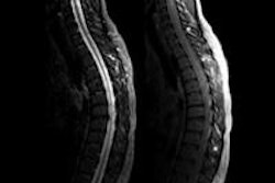 2013 11 14 16 41 54 722 2013 11 15 Mri Ms Spinal Cord Thumb 20131114234221