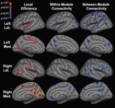 Inflated cortical surface representations show the significant differences across 1,015 regions of interest between the group of patients with temporal lobe epilepsy (TLE) and healthy subjects. Red, orange, and yellow indicate increases in TLE, while blue indicates decreases. Image courtesy of Radiology.