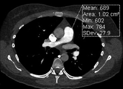 High-pitch CTPA
