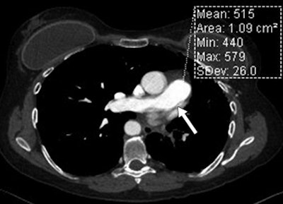 Standard CTPA in a 50-year-old woman (above) and high-pitch ECG-synchronized CTPA in a 53-year-old woman (below). Both patients weighed 79 kg. Signal intensity is represented by attenuation values (in mean HU) in main pulmonary artery. Motion artifact of the central pulmonary artery is noted in the standard CTA image above (arrow). Images republished with permission from AJR, November 2013, Vol. 201:5, pp. 971-976.