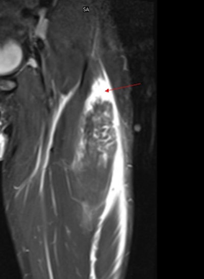 In spite of the growing use of mobile CT at sports stadiums, MRI has become the frontline modality for investigating football injuries. This MR image shows a muscle tear in a professional footballer diagnosed via PACSMail. Image courtesy of Drs. Jerry Healy and Justin Lee, Chelsea and Westminster Hospital, London.
