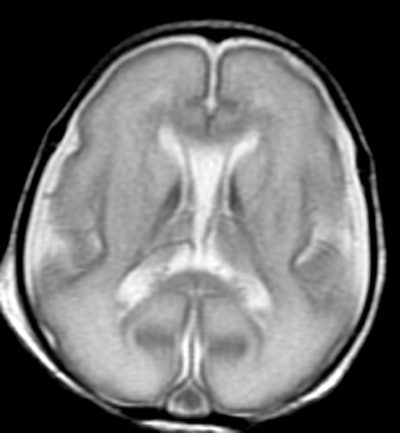 MR spectroscopy shows development in an infant born 15-weeks premature (above), compared with development in a full-term baby (below). Images courtesy of RSNA.