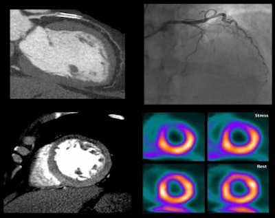 Image of CORE320 patient shows an occluded left anterior descending (LAD) stent on CT and catheterization, with the corresponding anterior wall defect demonstrated by CT perfusion and SPECT. Image courtesy of CORE320 investigators.