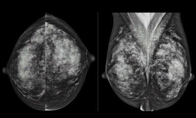 Images of woman with extremely dense breast tissue, which lowers the sensitivity of mammography. Courtesy of Dr. Wendie Berg, PhD.