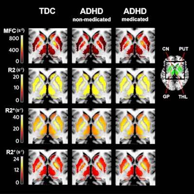 Images show nonmedicated ADHD patients have reduced striatal and thalamic MFC measures of brain iron, compared with controls and medicated ADHD patients. Brain iron measures in the putamen (PUT), caudate nucleus (CN), thalamic (THL), or globus pallidus (GP) did not differ between controls and medicated ADHD patients. The statistically significant differences are visible in the MFC group maps (top row) but not in conventional relaxation rate maps in the second, third, and bottom rows. Image courtesy of RSNA and Vitria Adisetiyo, PhD.