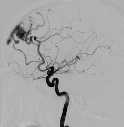 Lateral cerebral digital subtraction angiography image acquired using Infinix VF-i biplane system, showing a large arteriovenous malformation. Image courtesy of Toshiba.