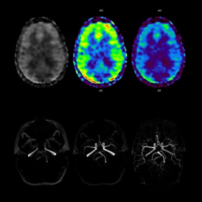 3D ASL perfusion imaging correlates with Toshiba's 3D ASL MR angiography technology to demonstrate uniform filling of both brain hemispheres. Image courtesy of Toshiba.