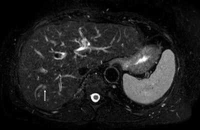 Fat-suppressed T2-weighted fast spin-echo MR image obtained in 61-year-old man with liver metastases from colorectal cancer. Only one metastasis in the right liver lobe is seen on this slice (arrow). Moreover, this lesion is barely seen because it is located next to a vessel. Images courtesy of Dr. Valerie Vilgrain.