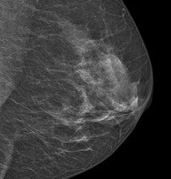 An image acquired with Philips' MicroDose SI system. Image courtesy of Philips.