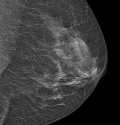 An image acquired with Philips' MicroDose SI system. Image courtesy of Philips.