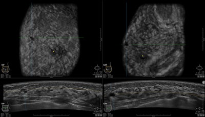 An image from GE's Invenia ABUS scanner, which the company is featuring at RSNA 2013.