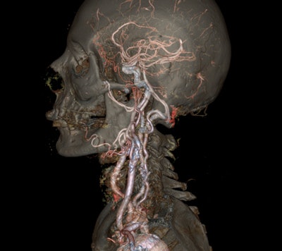 Image acquired with Revolution CT scanner demonstrates carotid arteries. Courtesy of GE.
