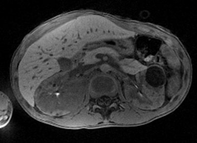 With Siemens' StarVIBE technology, no breath-hold is needed. The images above and below show the increase in image quality with StarVIBE. Images courtesy of Siemens.