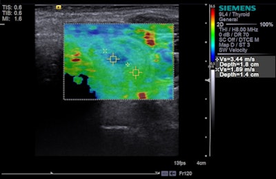 Tissue strain analysis of a thyroid lesion using Virtual Touch IQ. Image courtesy of Siemens.