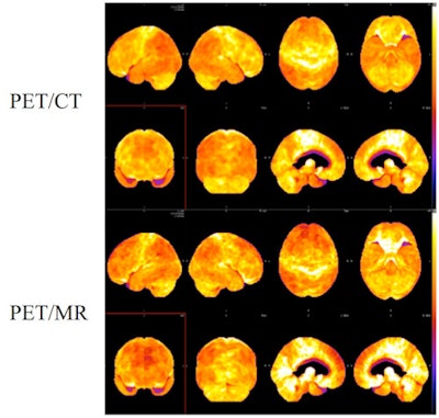 3D surface projections of FDG-PET data in a patient with Alzheimer's disease. PET/CT (top two rows) followed by PET/MRI (bottom two rows) using the same tracer injection showed similar diagnostic results. Image courtesy of Dr. Kent Friedman.