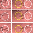 2013 12 05 12 32 29 678 Shin 8mm Sessile Polyp 500 20131205193600