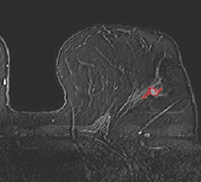 Breast DCE-MR images acquired on a 3-tesla scanner. Top, pure DCIS; below, invasive with DCIS; bottom, invasive cancer. Shown in these slices are the computer 3D lesion segmentation results. Images courtesy of Maryellen Giger, PhD.