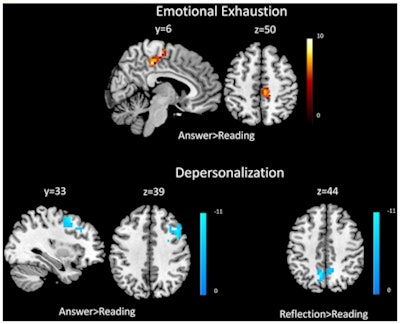 Top: Covariate results for emotional exhaustion and beta values for the answer phase compared with the reading phase for residents. Bottom row: Covariate results for depersonalization and answering vs. reading (left) and reflection vs. reading (right) for residents. The color bar denotes the t-scores of the estimated slope of the beta values versus the covariate. Image republished from Durning et al in Frontiers in Psychiatry.