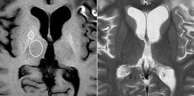 MRI of a 45-year-old woman with glioblastoma treated with surgery, chemotherapy, and radiation therapy. Unenhanced T1-weighted image (above, left) shows high-signal-intensity globus pallidus. Fast spin-echo T2-weighted image (above, right) at same level. Unenhanced T1-weighted image (below, left) shows high-signal-intensity dentate nucleus. Fast spin-echo T2-weighted image (below, right) at same level. Images courtesy of Radiology.