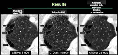 Chest CT images of a 66-year-old man (body mass index, 21) with emphysema. Margins of air pockets are equal in all three images. No streaking artifacts are present in sparsely sampled sub-mSv with iterative reconstruction, even at 91% dose reduction. Images courtesy of Dr. Ranish Khawaja and Dr. Mannudeep Kalra.