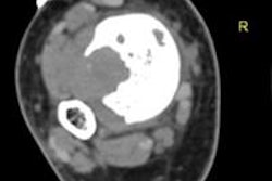 2013 12 19 13 38 19 382 2013 12 20 Bony Lesion Regab bottom 20140103172436