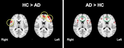 The ASL-fMR images show group differences in cerebral circulation-based functional activation in the frontal lobe between people with early Alzheimer's disease (AD) and those with cognitive healthy (HC) aging in a memory-encoding task. During memory encoding, significantly decreased activation was found in the AD group relative to healthy subjects (primarily in ventral medial and bilateral prefrontal areas). Increased activation in AD was observed mostly in the anterior cingulate cortex, suggesting that enhanced attention was required to successfully encode new information. Images courtesy of Steven Beyea, PhD.