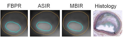 Coregistered filtered back projection reconstruction (FBPR)/ASIR/MBIR 'triplet' with histology. Images courtesy of Dr. Stefan Puchner.