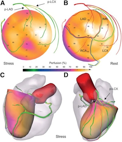 SMARTVis images of a 61-year-old man. (A) 2D stress polar map fused with projection of coronary tree extracted from CT angiography (CTA). Coronary vessel tree is color-coded with automatically estimated degree of stenosis. (B) Rest polar map fused with projection of coronary tree extracted from CTA. Coronary arteries are coded with distance to epicardium. Patient-specific perfusion territories are also projected. (C and D) 3D model of heart and coronary artery tree extracted from CTA fused with 3D stress polar map. Image courtesy of JNM.