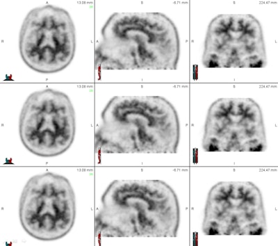The set of images shows how readers viewed florbetapir PET results from patients in axial, sagittal, and coronal planes to evaluate levels of beta-amyloid deposition. Images courtesy of Dr. Ameya Nayate.