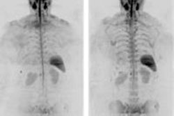 2014 01 28 16 52 57 590 Dwi Myeloma Giles Rad Image01 20140128235750