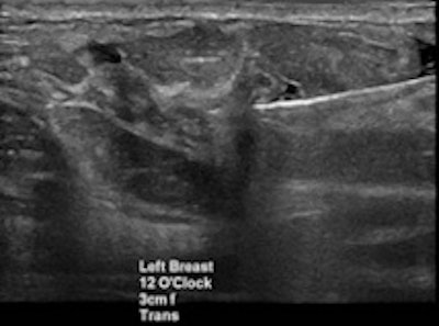 Targeted ultrasound for the palpable lump in the left breast showed vague hypoechoic area at 12 o’clock which was core biopsied under ultrasound guidance (left). Pathology of left breast ultrasound core biopsy was benign, however at multidisciplinary breast care conference, pathology result was found to be discordant with imaging findings on ultrasound, and further evaluation with breast MRI (right) showed an irregular enhancing left breast mass in the upper, central to inner breast which was confirmed to be invasive ductal carcinoma on excisional biopsy.
