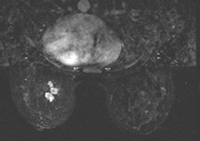 2014 01 29 09 36 04 992 2014 01 29 Arab Health Breast Fig 4 Breast Mri Left Breast Mass