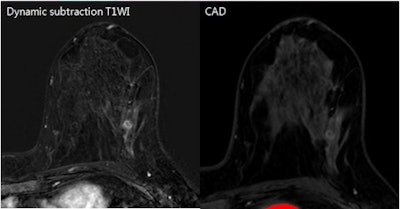 False-negative breast MRI CAD result in patient with an approximately 1-cm metaplastic carcinoma in her left breast. Contrast-enhanced subtraction image (left) shows an irregular rim-enhancing mass, suggesting a typical malignant-looking mass. MRI CAD results (right) did not show a color map, however. The patient had a low Ki-67 percentage. Images courtesy of Dr. Seon Hyeong Choi.