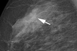 2014 02 03 15 31 24 261 Photon Counting Mammography 500 20140203223354