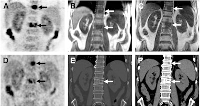 Images of bone metastases (arrows) in a 69-year-old man presenting for staging of oropharyngeal cancer: PET/MRI with coronal PET (A), coronal T1-weighted Dixon MRI sequence (B), and coronal T1-weighted TSE MR sequence (C). PET/CT scan includes coronal PET (D) and coronal bone (E) and soft-tissue CT (F). Two metastases in spine show intense uptake in both PET datasets (A and D). Replacement of bone marrow is seen in both T1-weighted Dixon MRI sequence (B) and T1-weighted TSE MR sequence (C), with better lesion delineation in TSE than in VIBE Dixon because of higher in-plane resolution. Faint sclerosis is present as anatomic correlate of caudal metastases in both bone window (E) and soft-tissue window (F) on CT, whereas cranial metastasis is depicted only in soft-tissue image. Images courtesy of JNM.