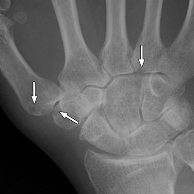 Images are of a 67-year-old man with rheumatoid arthritis. Bone erosion with significant overlapping of bones (arrows) can be difficult to evaluate on radiography (above), compared with tomosynthesis (below and bottom). Images courtesy of AJR.