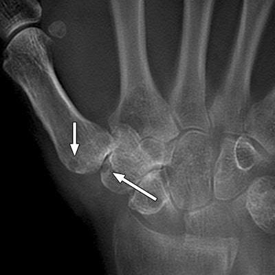 Tomosynthesis of rheumatoid arthritis