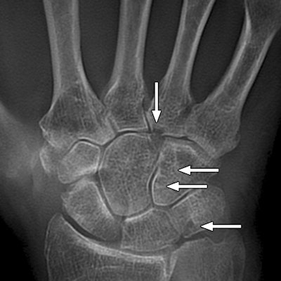 Tomosynthesis of rheumatoid arthritis